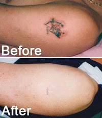 Redeem Semi permanent makeup and tattoo removal, Harrogate 381175 Image 4